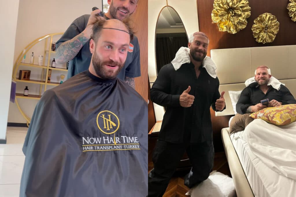 Chris Bumstead Hair Transplant