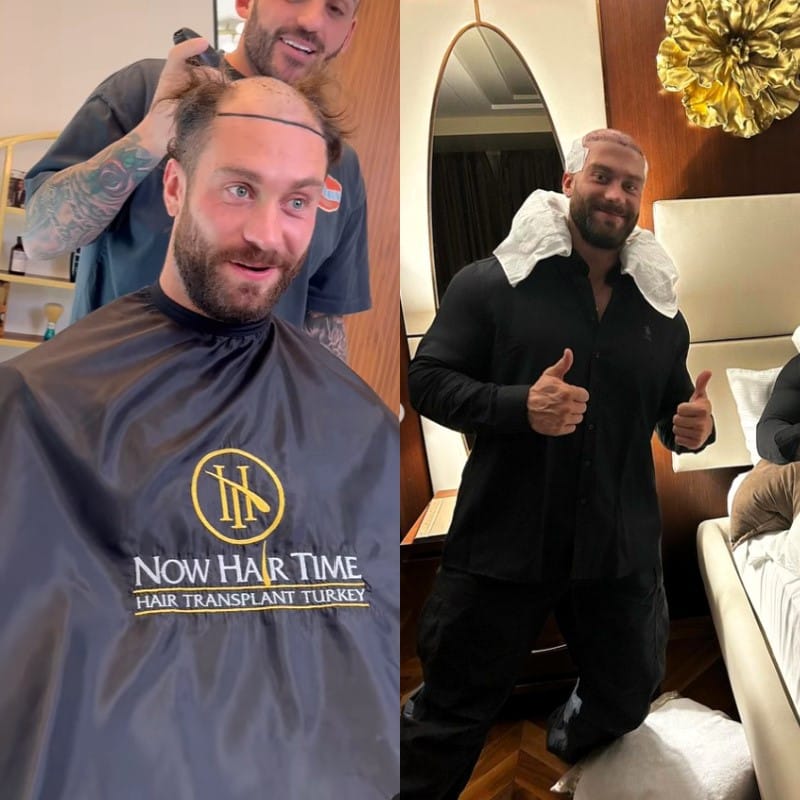 Chris Bumstead Hair Transplant