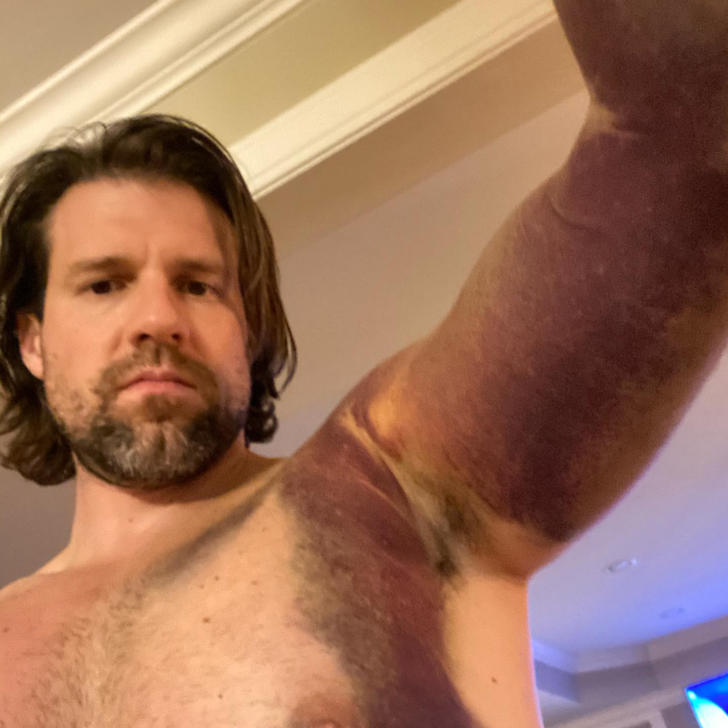 Matthew Sonak Torn Pectoral Muscle