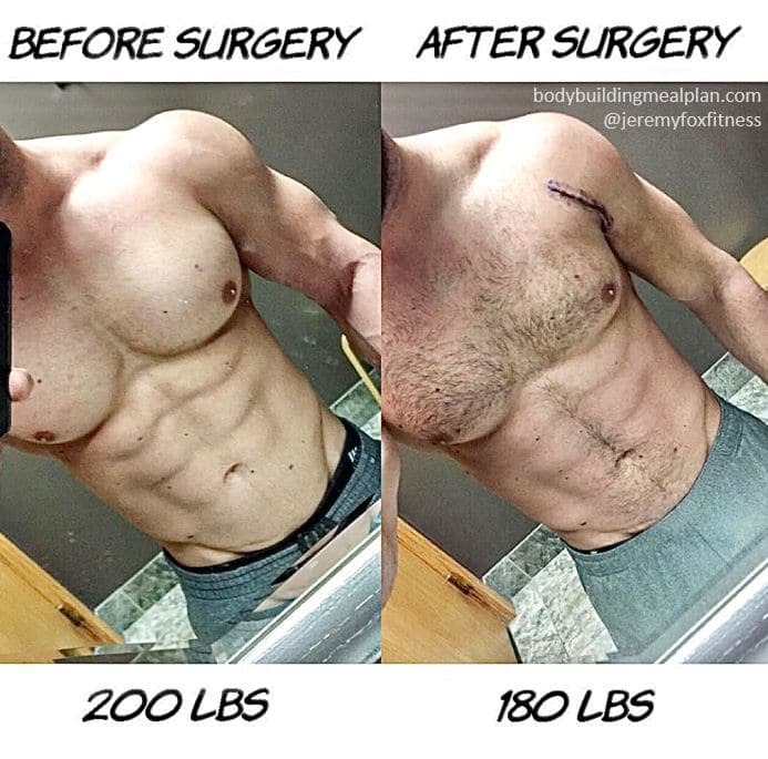 Torn Pectoral Muscle Rehab