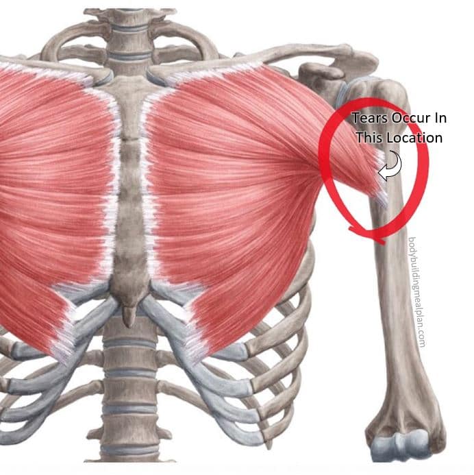 Torn Pectoral Muscle Location