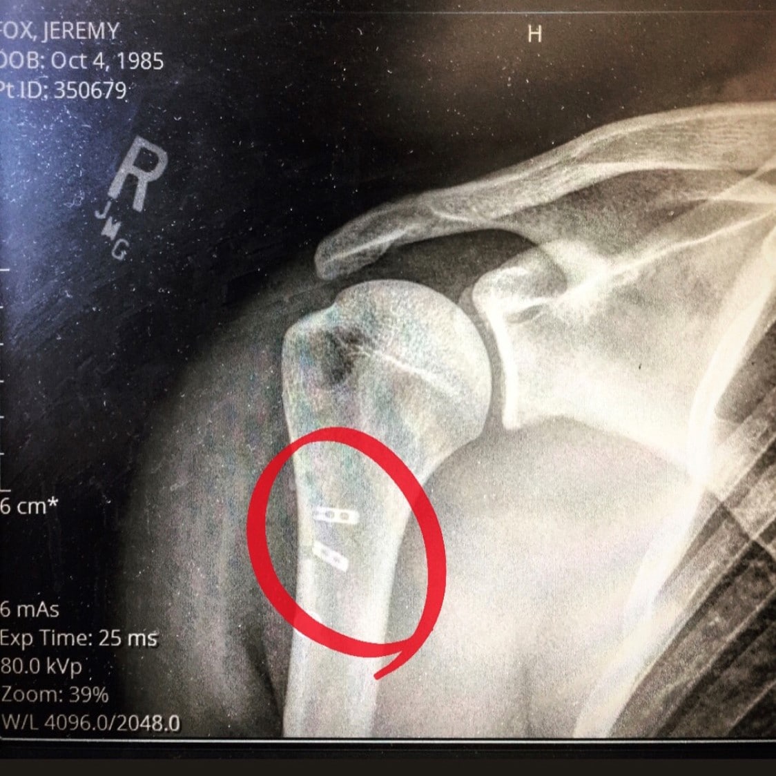 Torn Pectoral Muscle X-ray